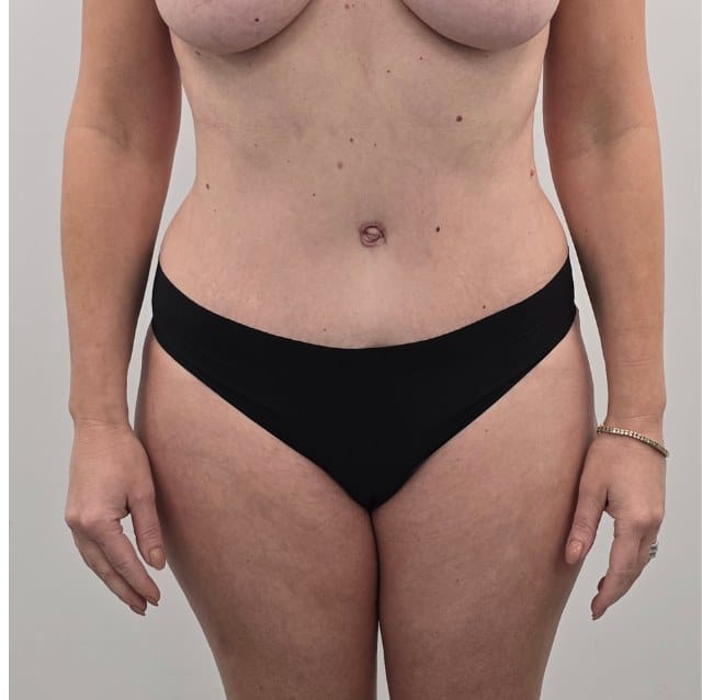 Abdominoplasty metin front after