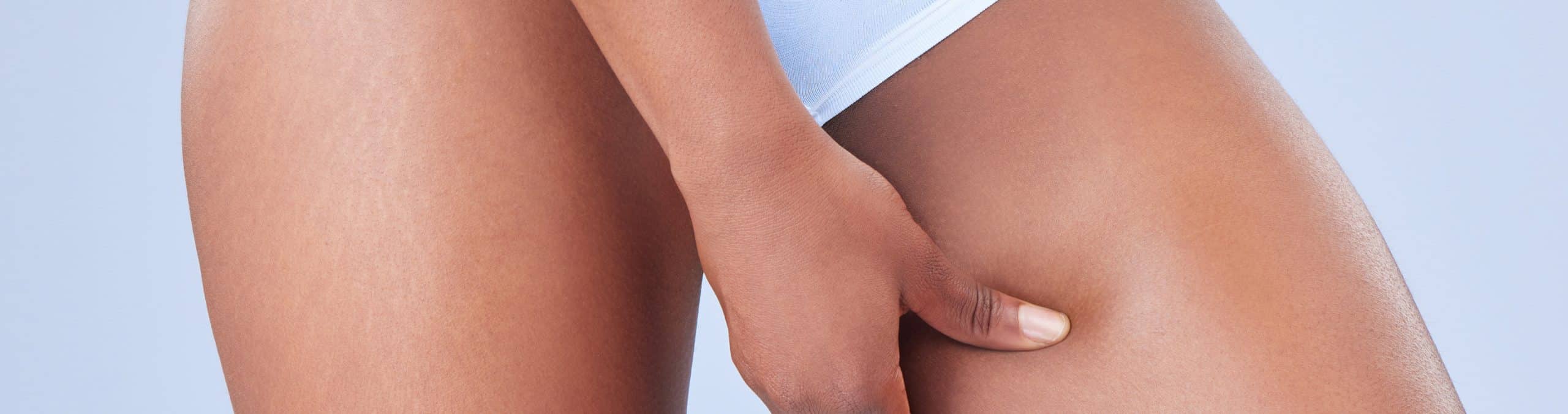 Beauty skincare legs with black woman pinching her skin studio blue background wellness health wellness diet with…