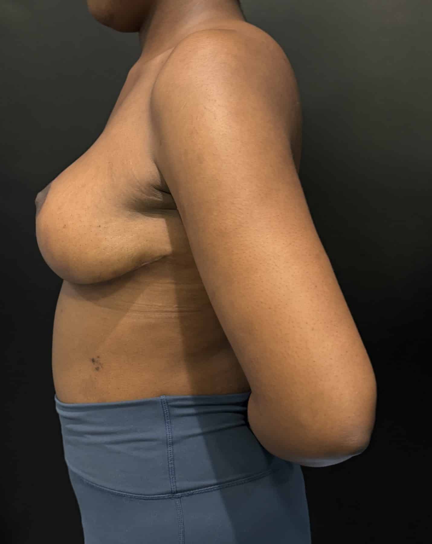 Breast reduction lara p1 angle 01 after
