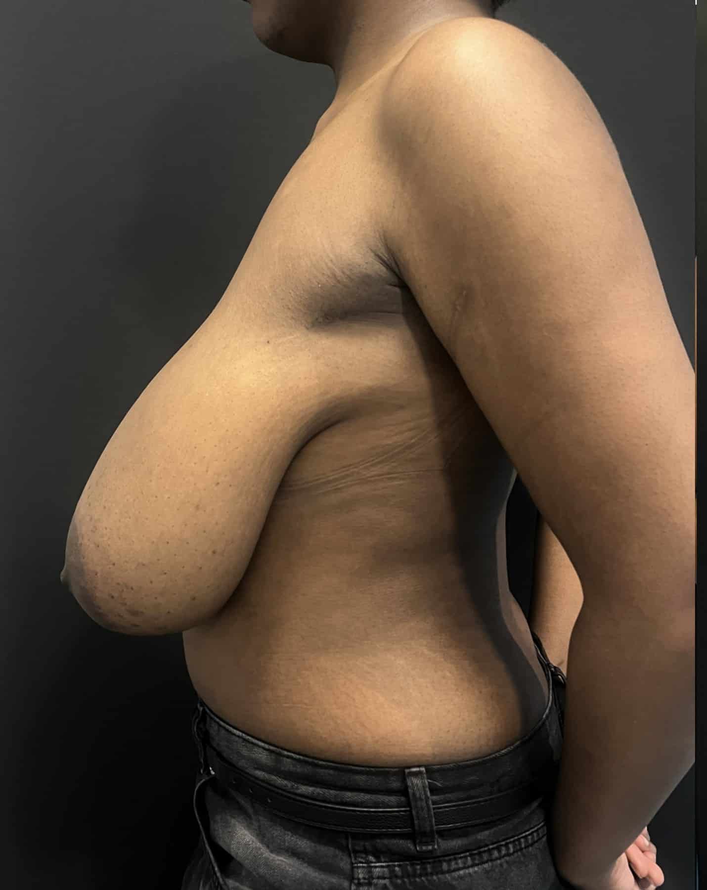 Breast reduction lara p1 angle 01 before