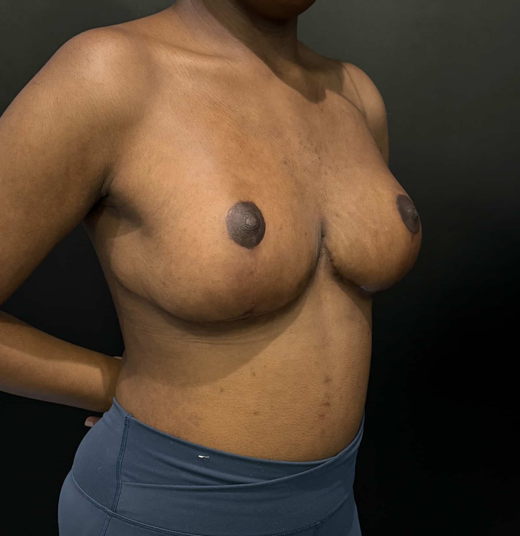 Breast reduction lara p1 angle 02 after