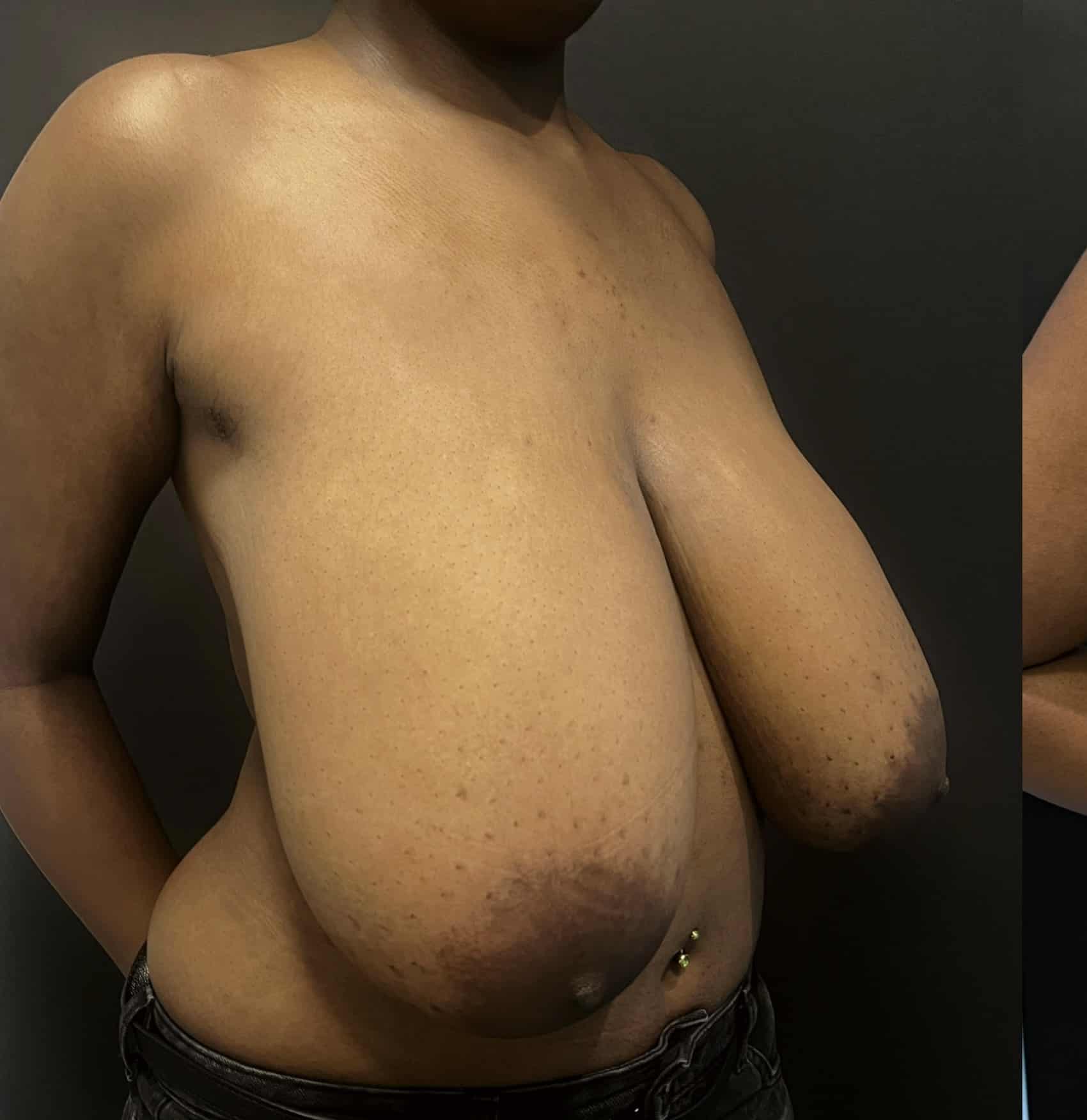 Breast reduction lara p1 angle 02 before