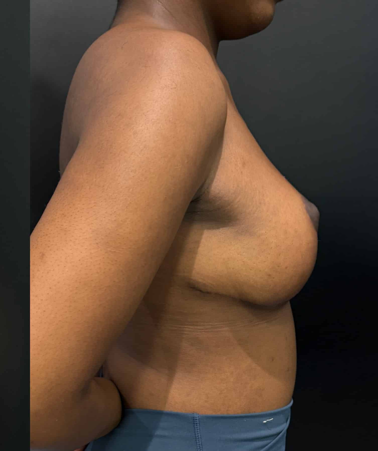 Breast reduction lara p1 angle 03 after