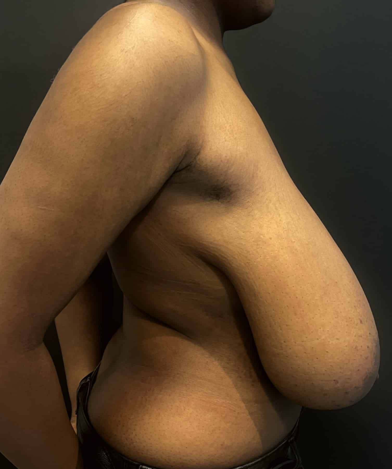 Breast reduction lara p1 angle 03 before
