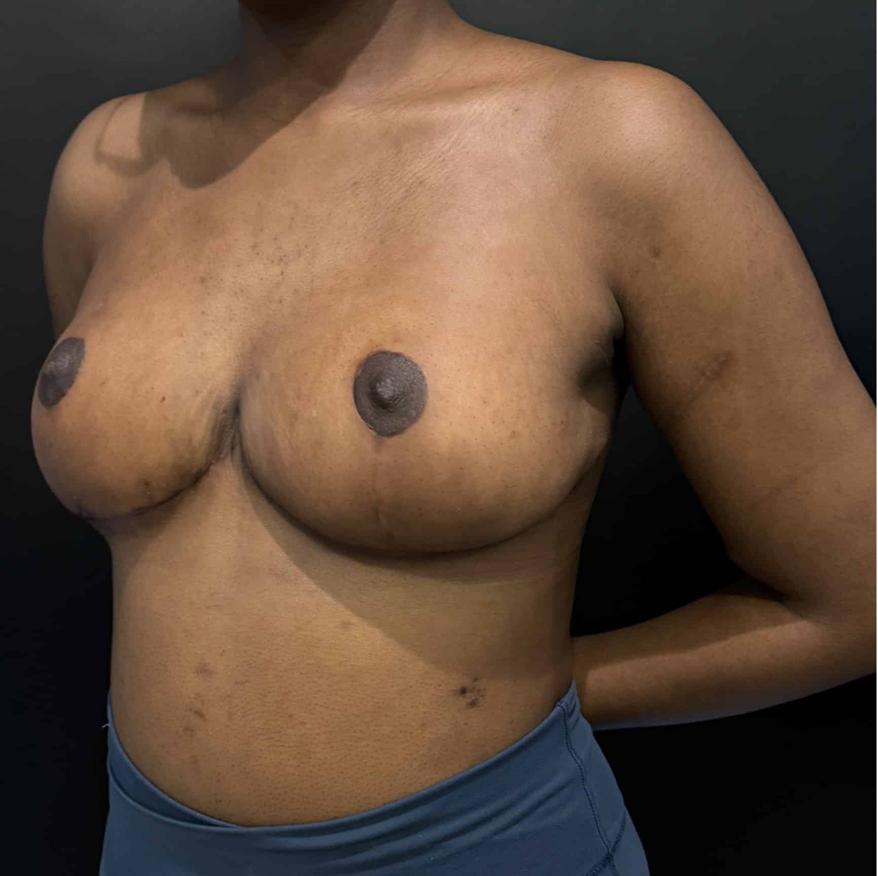 Breast reduction lara p1 angle 04 after