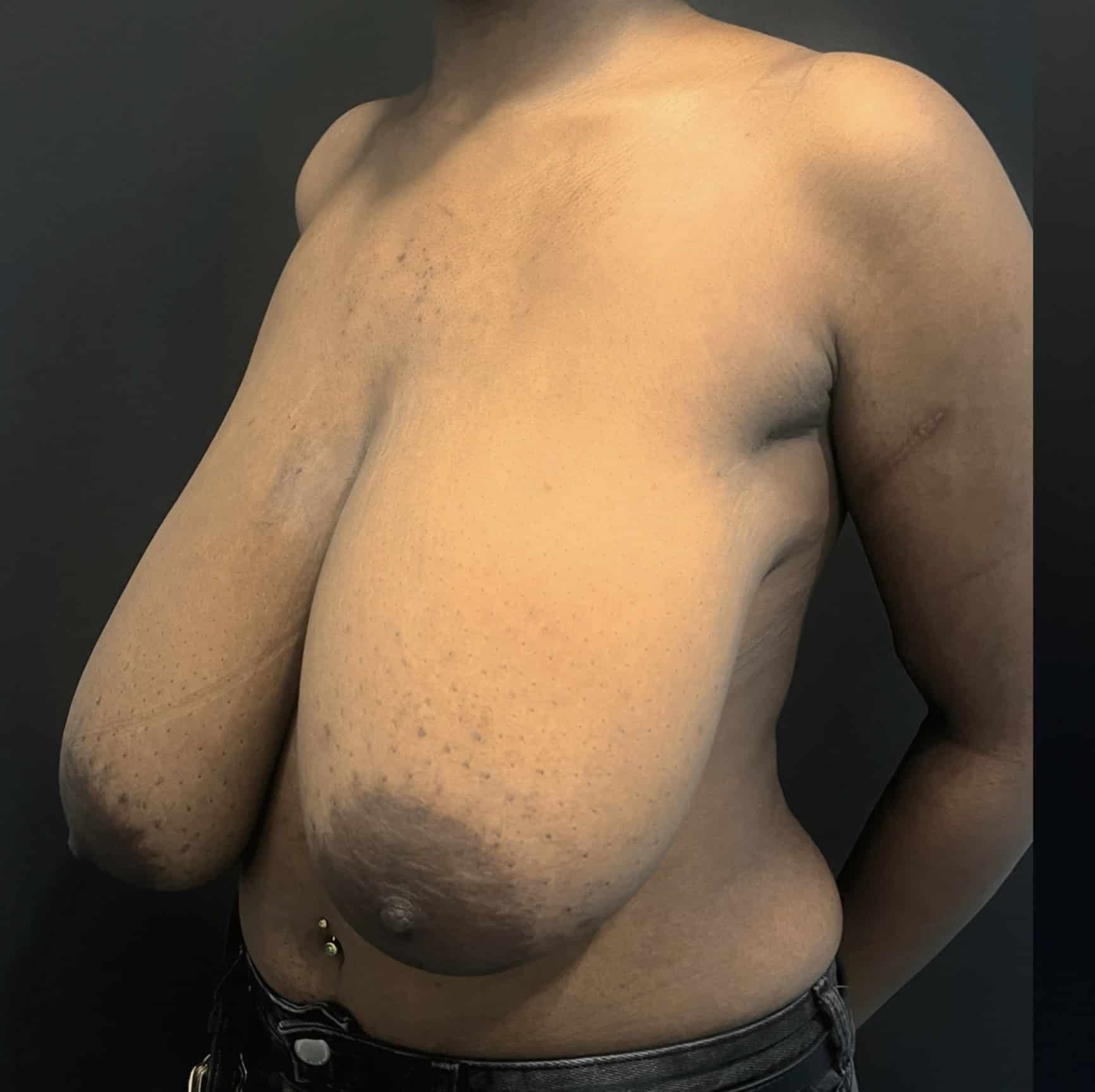 Breast reduction lara p1 angle 04 before