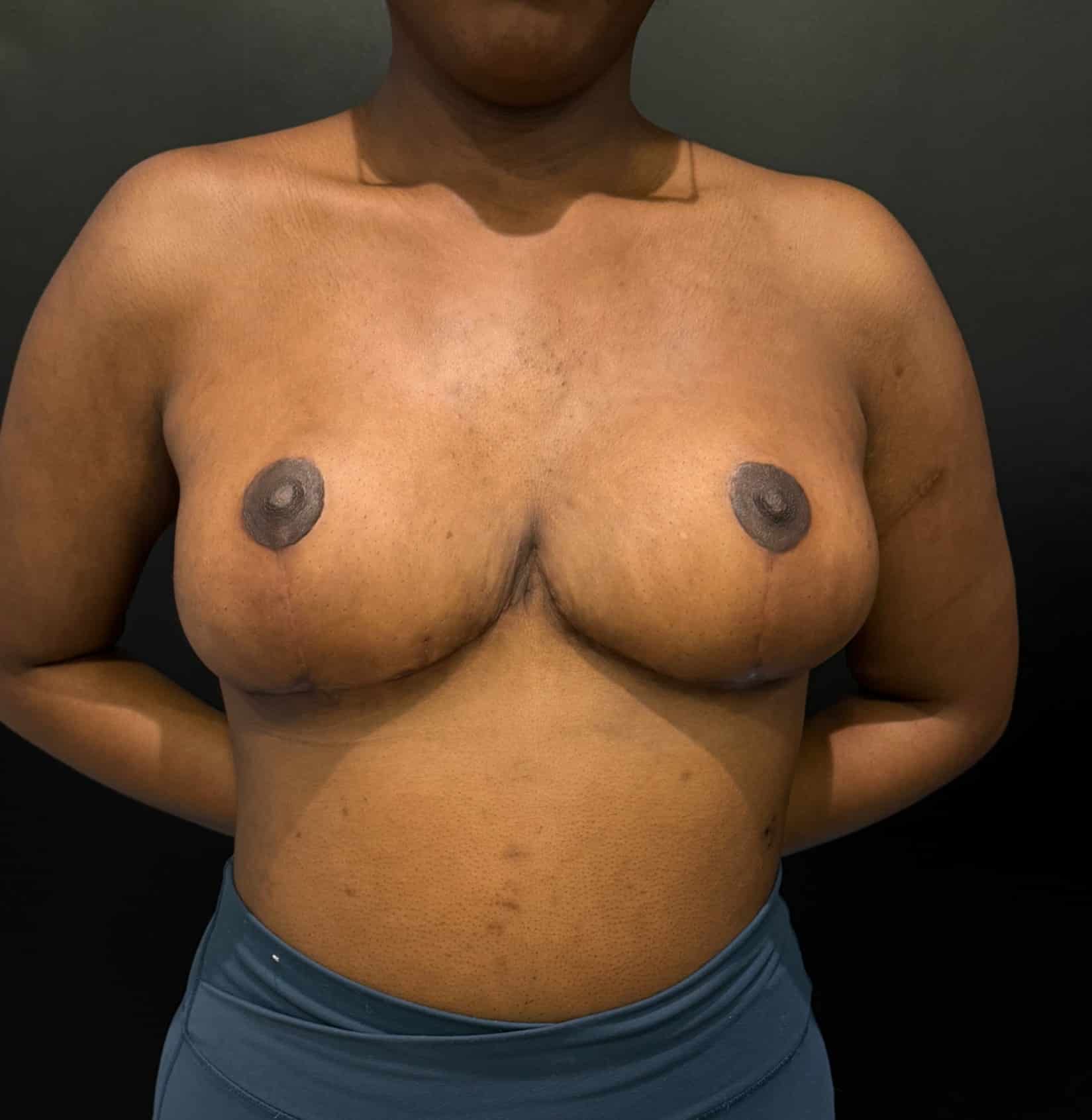 Breast reduction lara p1 angle 05 after
