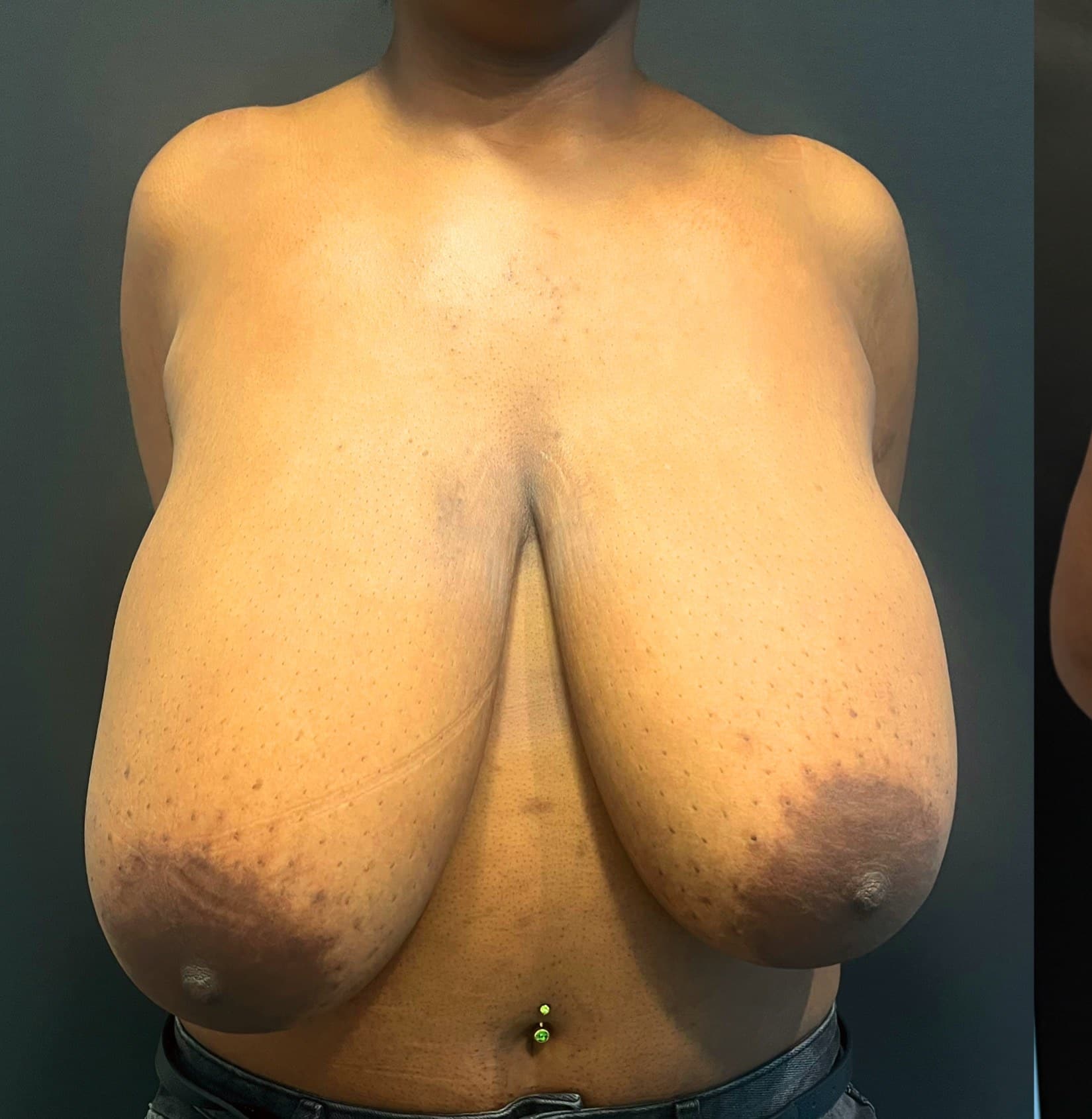 Breast reduction lara p1 angle 05 before