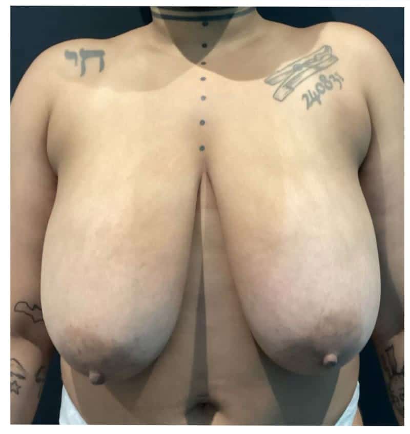 Breast reduction metin p1 angle 01 before
