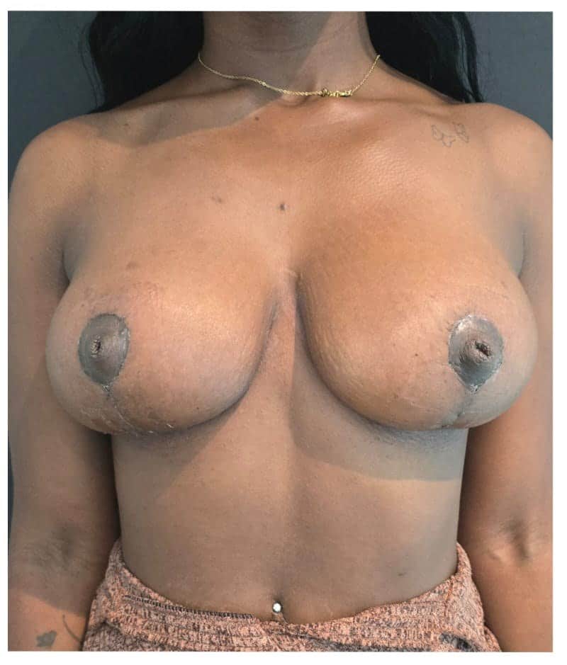 Breast reduction metin p1 angle 02 after