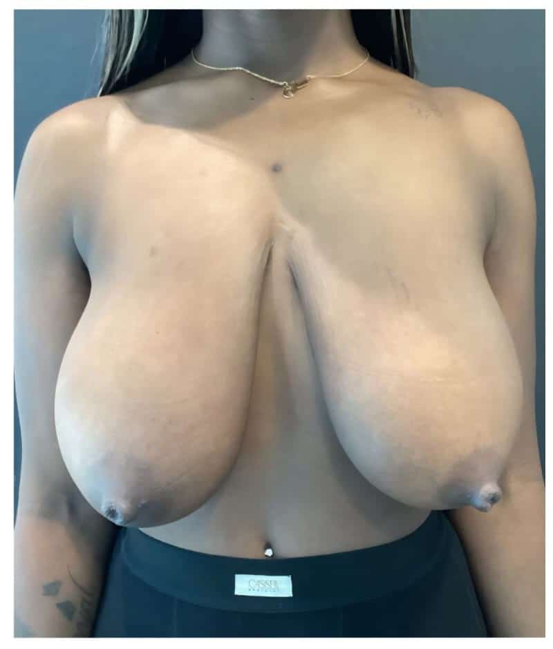 Breast reduction metin p1 angle 02 before