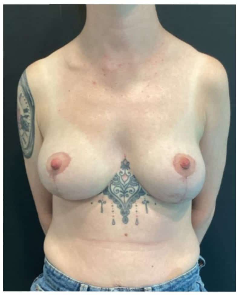 Breast reduction metin p1 angle 03 after