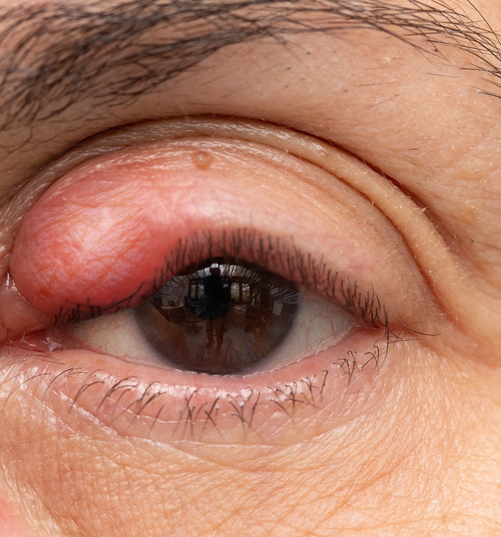 Chalazion lady s eye swelling inflammation upper eyelid redness triggered by allergy 1 1