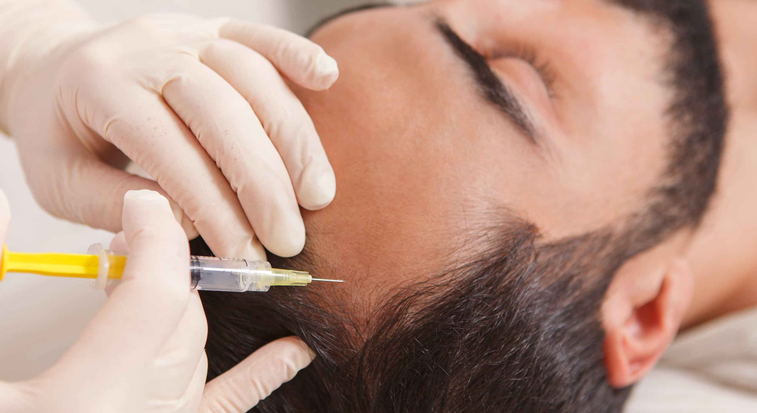 Close up cosmetologist injecting vitamins scalp balding man 1