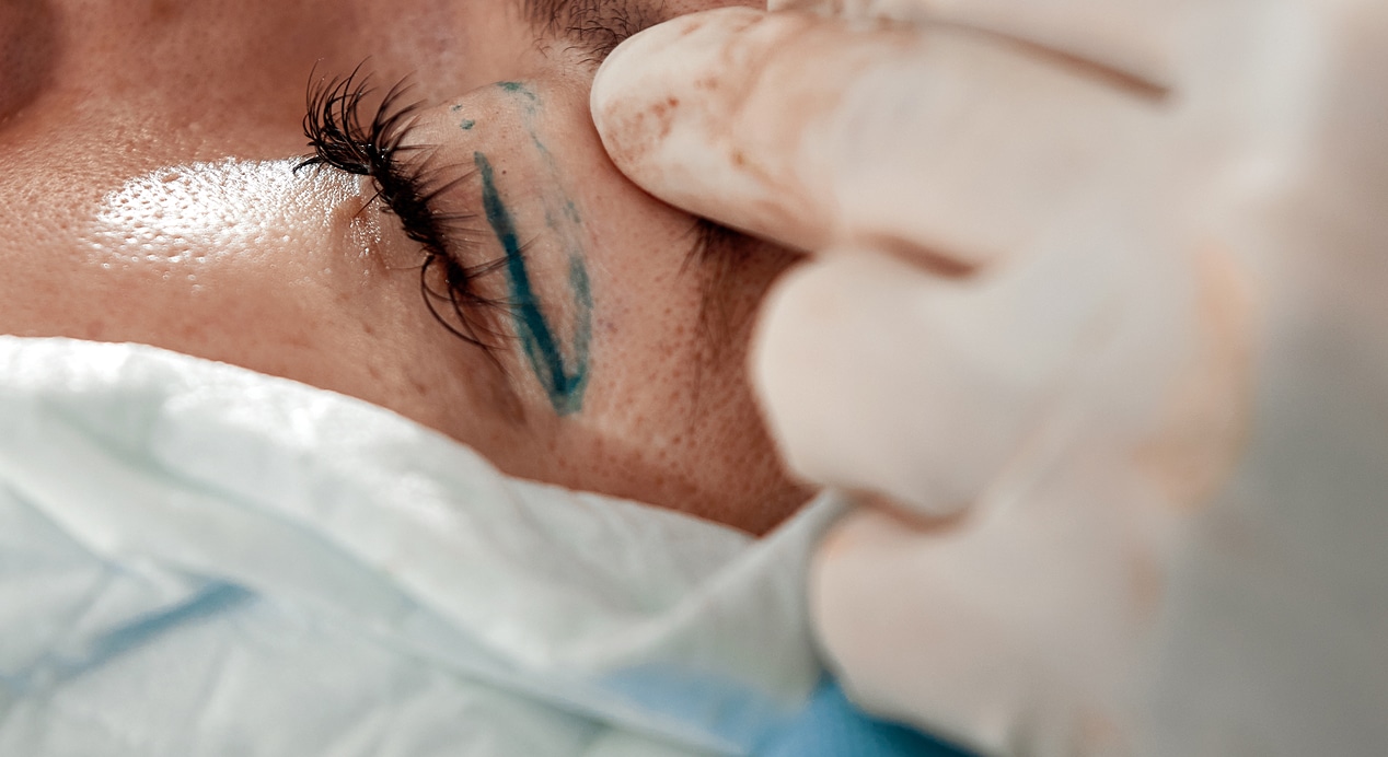 Close up face patient who is undergoing blepharoplasty surgeon cuts eyelid performs manipulations using medical…
