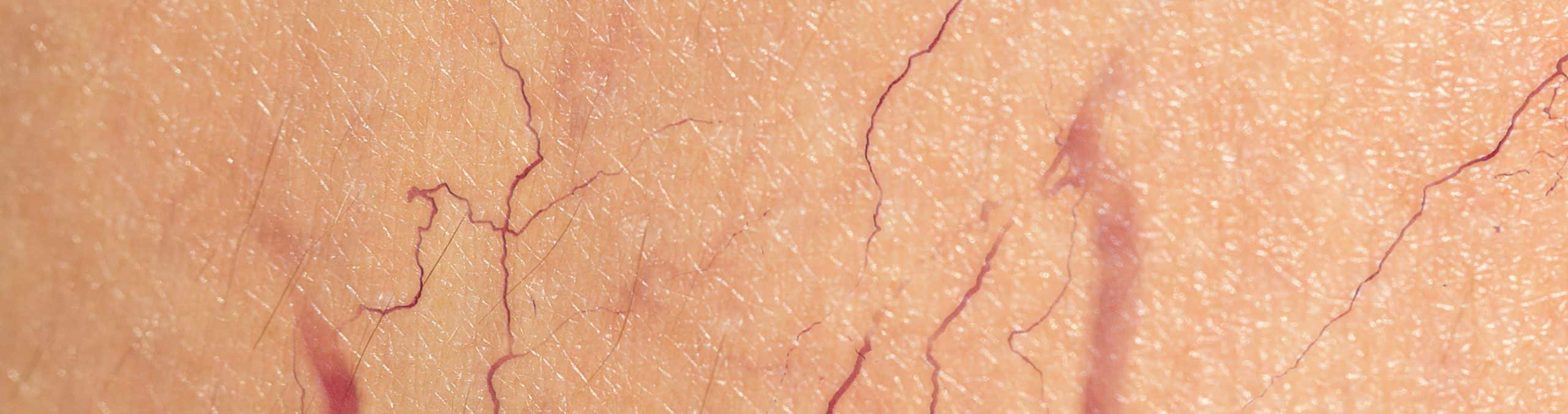 Close up leg skin with varicose veins 1