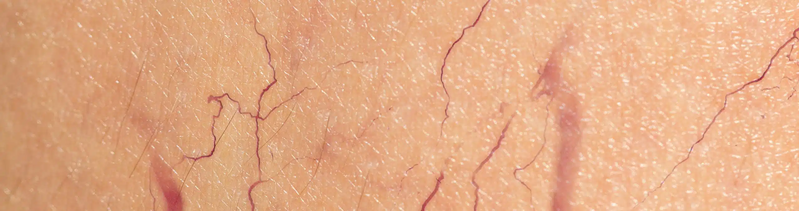 Close-up of leg skin with visible varicose veins