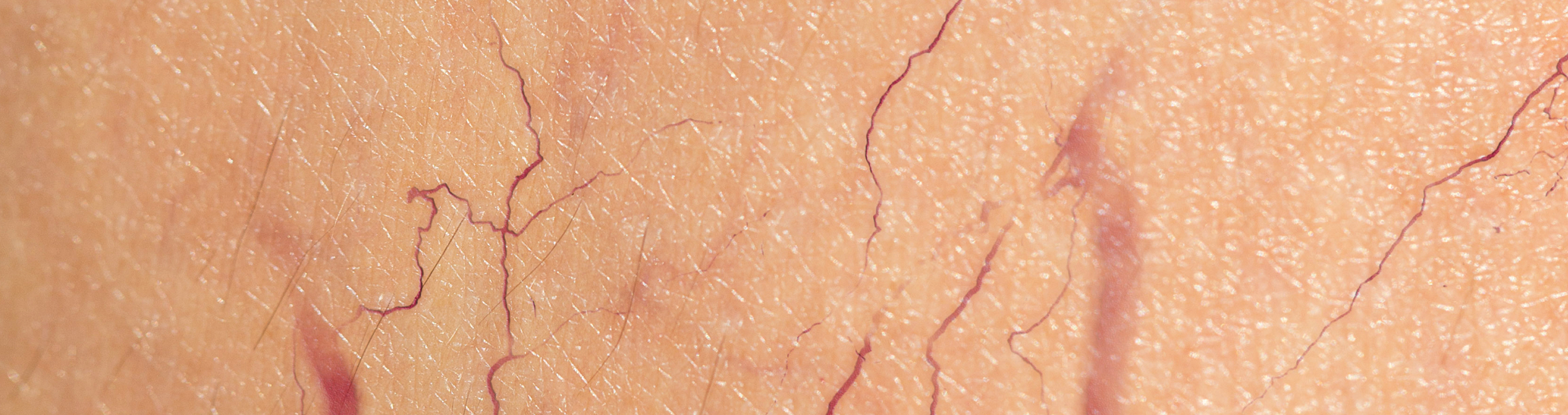 Microsclerotherapy for Thread Veins at Battersea Hospital