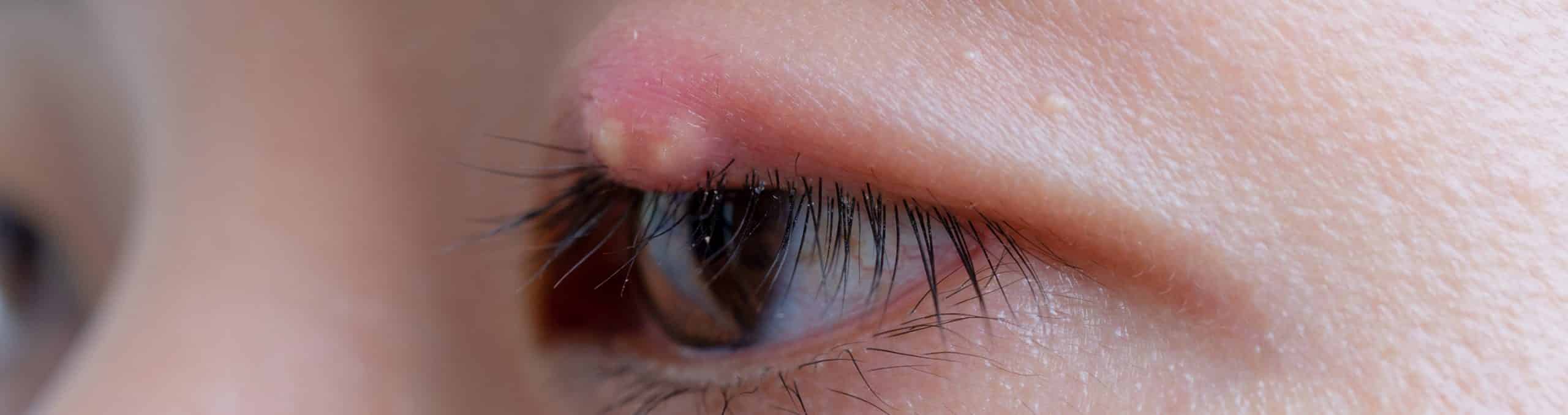Close up swollen human eye 1