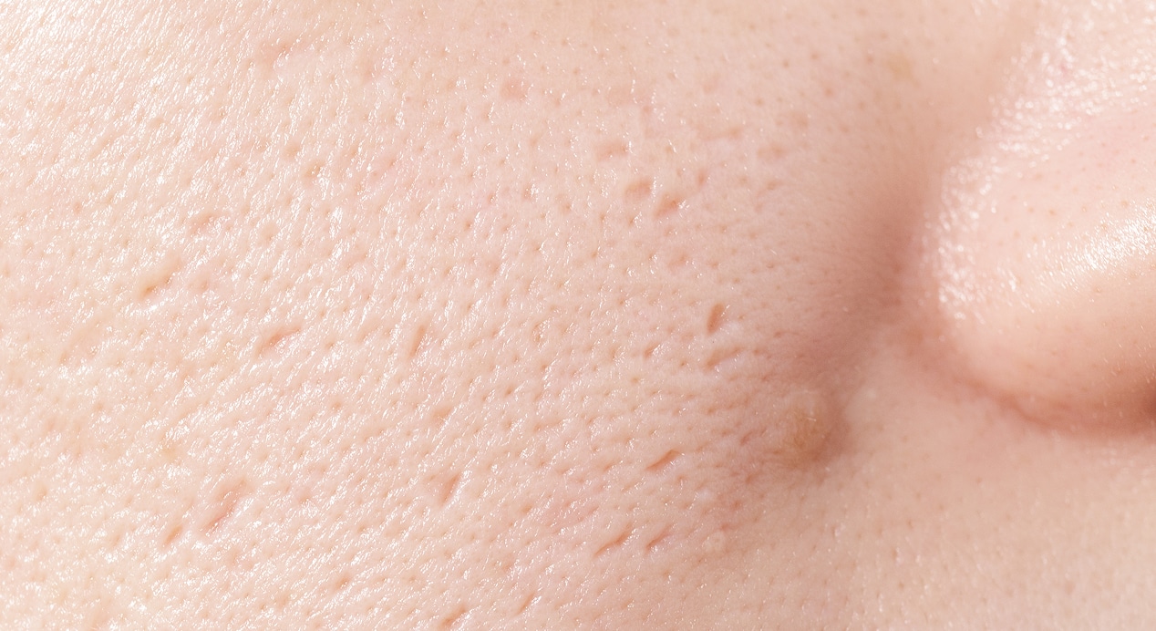 Close up woman face has problems with skin problems with acne scar female skin 1