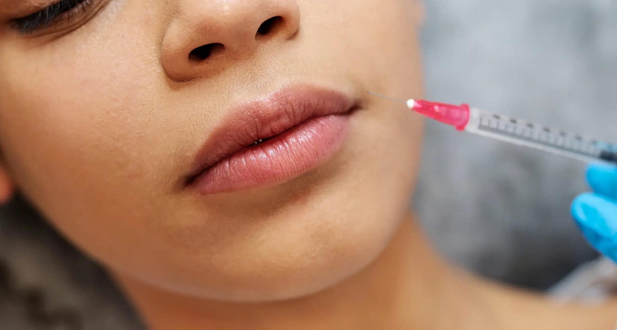 Lip Fillers treatment at Battersea Hospital