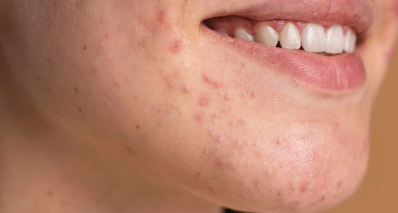 Confident young woman with acne close up 1