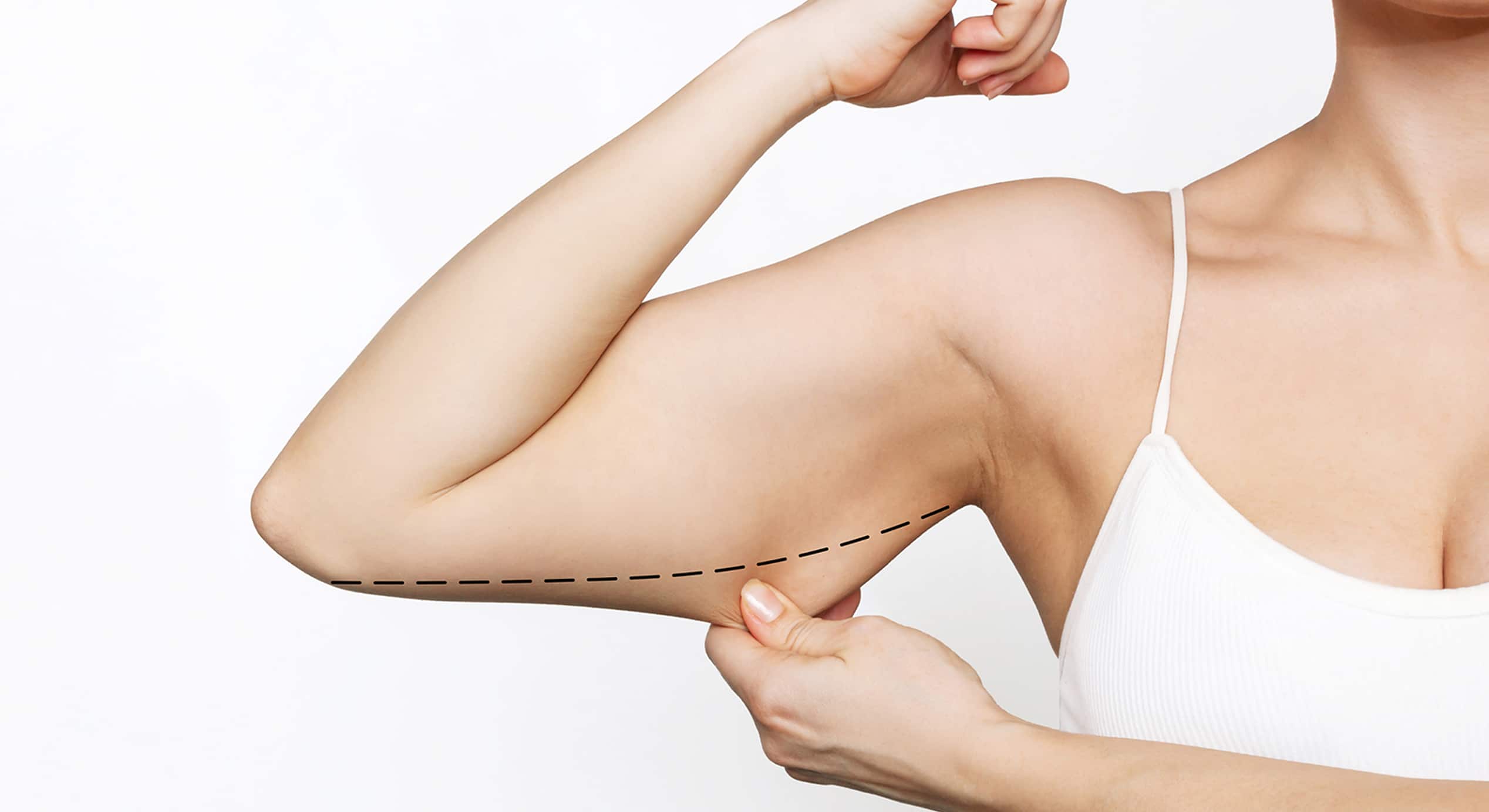 Cropped shot young caucasian slim woman grabbing skin her upper arm with marks liposuction 1 1