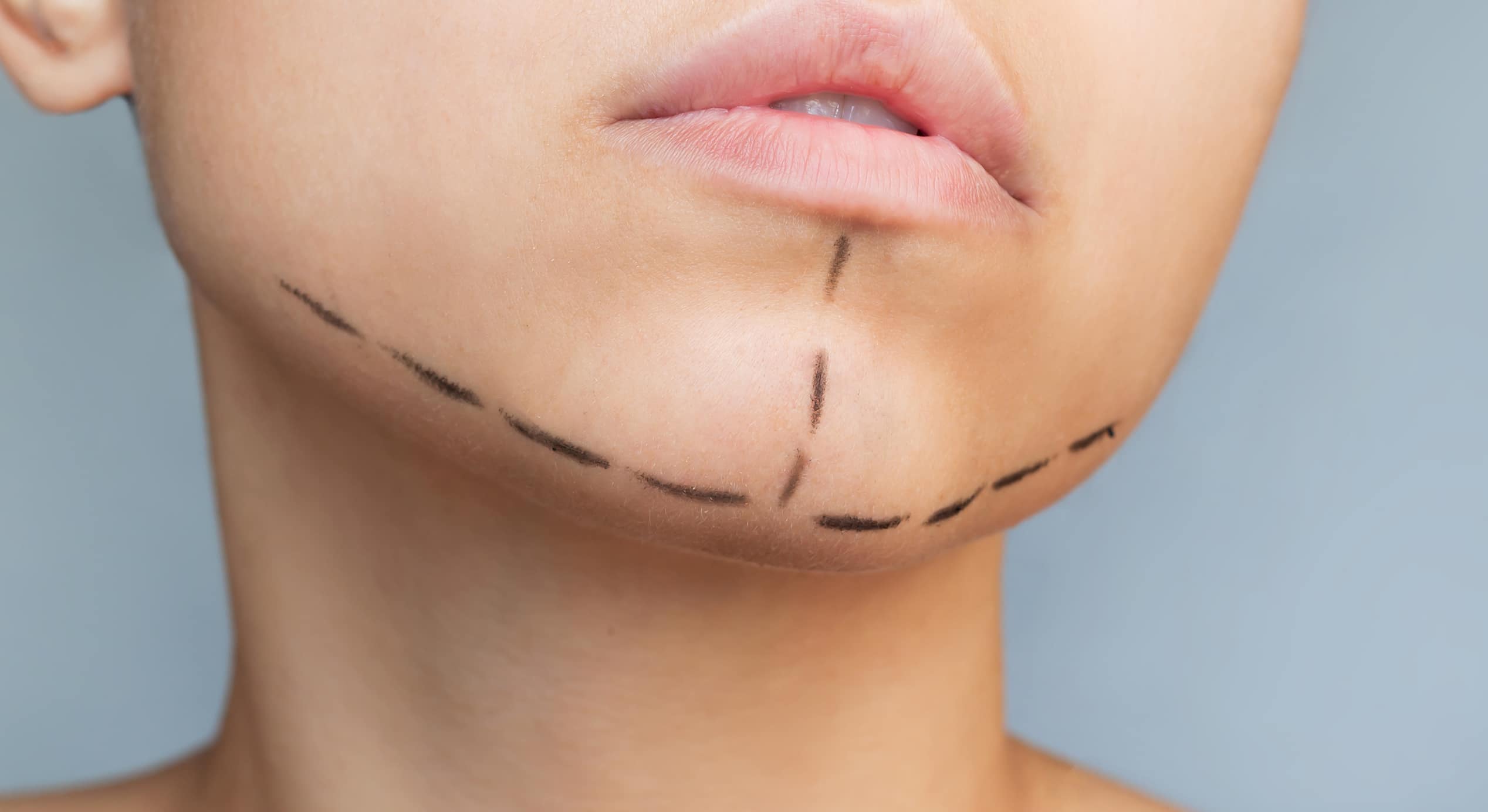 Cropped shot young caucasian woman with marking her chin jaws facial plastic surgery 1