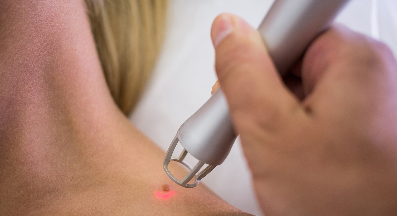 Dermatologist removing mole from womans shoulder 1