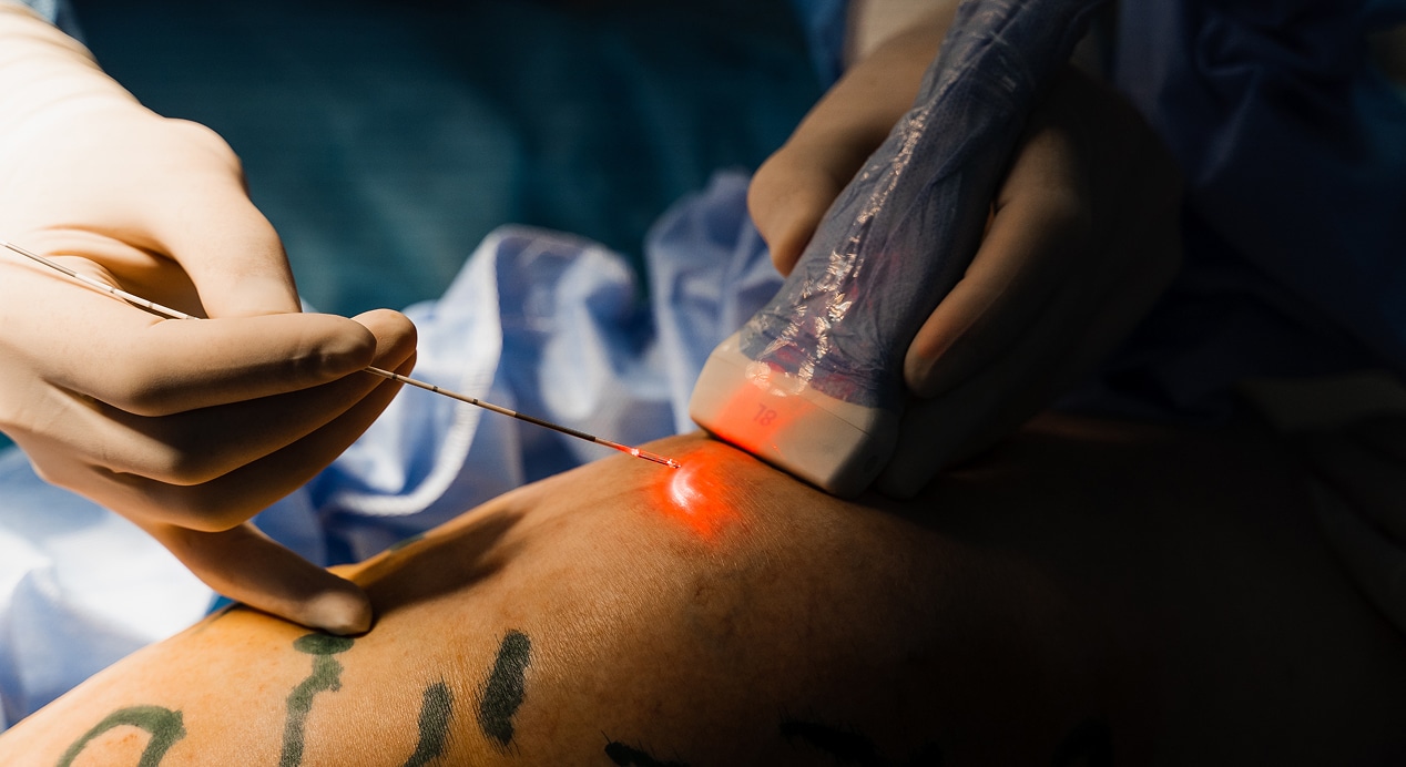 Endovenous laser coagulation treatment varicose veins ultrasound machine vascular surgeon with evlt red laser optical…