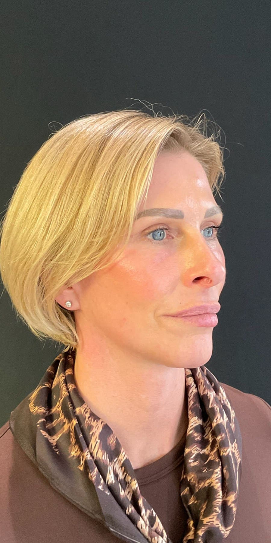 Facelift kshem angle 01 after
