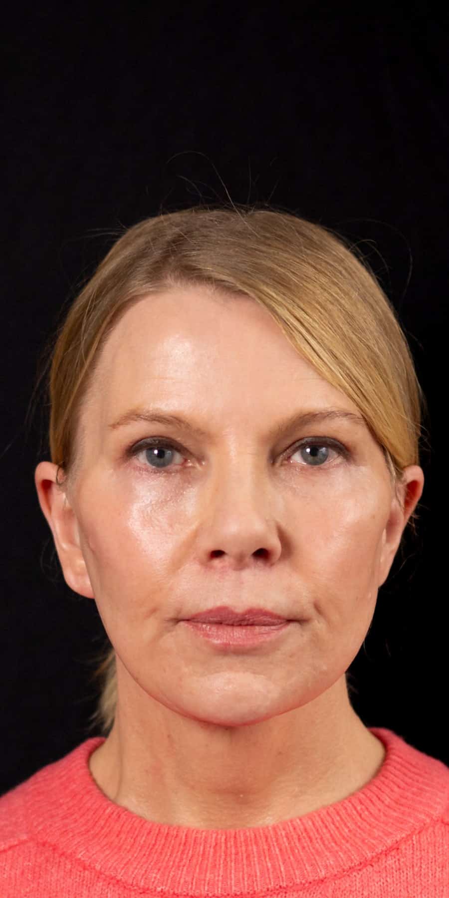 Facelift kshem angle 02 after