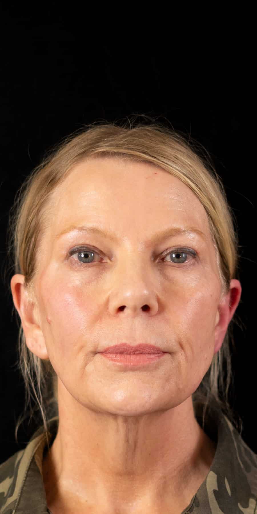 Facelift kshem angle 02 before