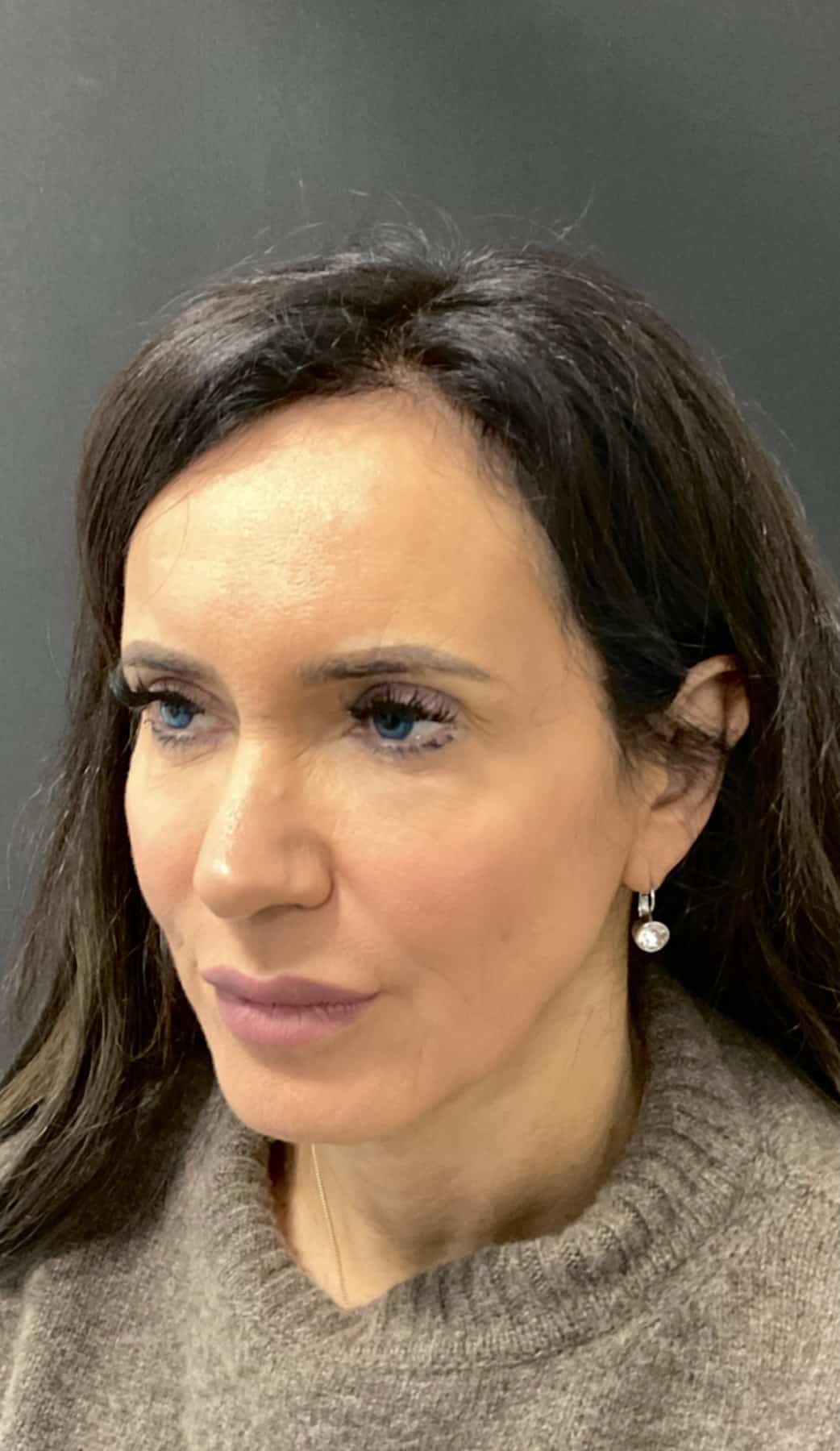 Facelift kshem angle 03 before