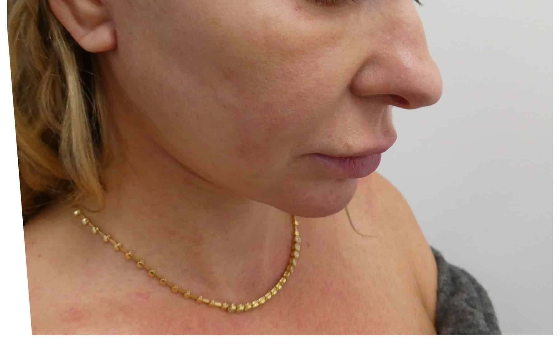 Facelift metin profile after