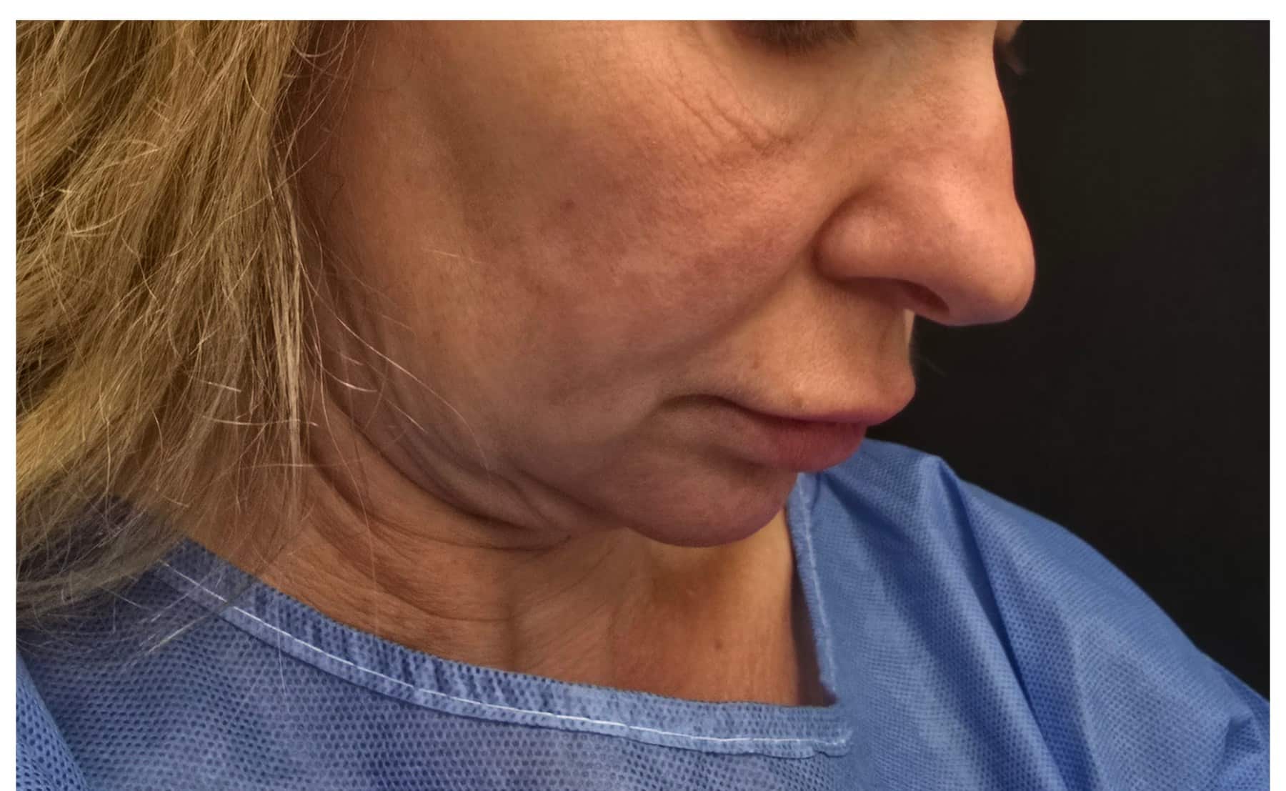 Facelift metin profile before