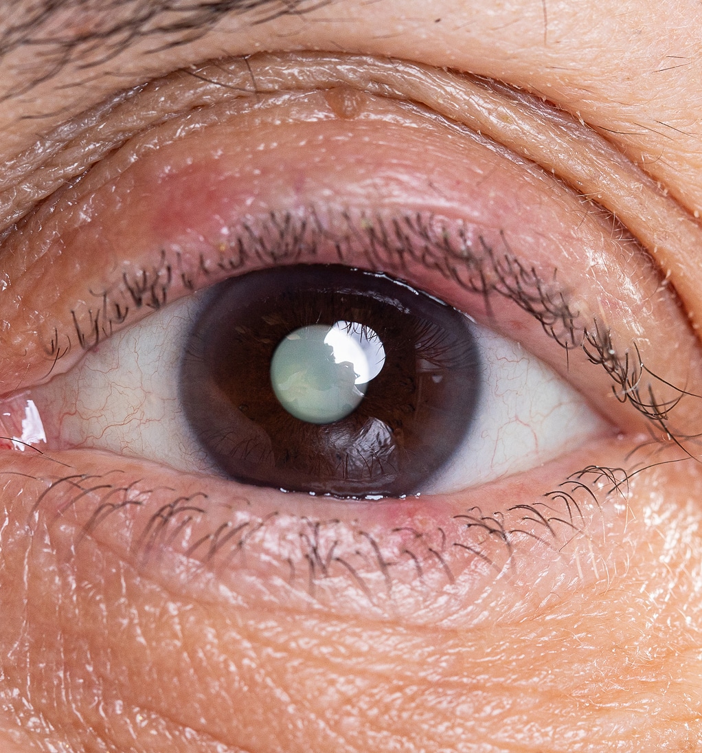 Female eye showing cataract which can lead partial loss vision blindness 1 1