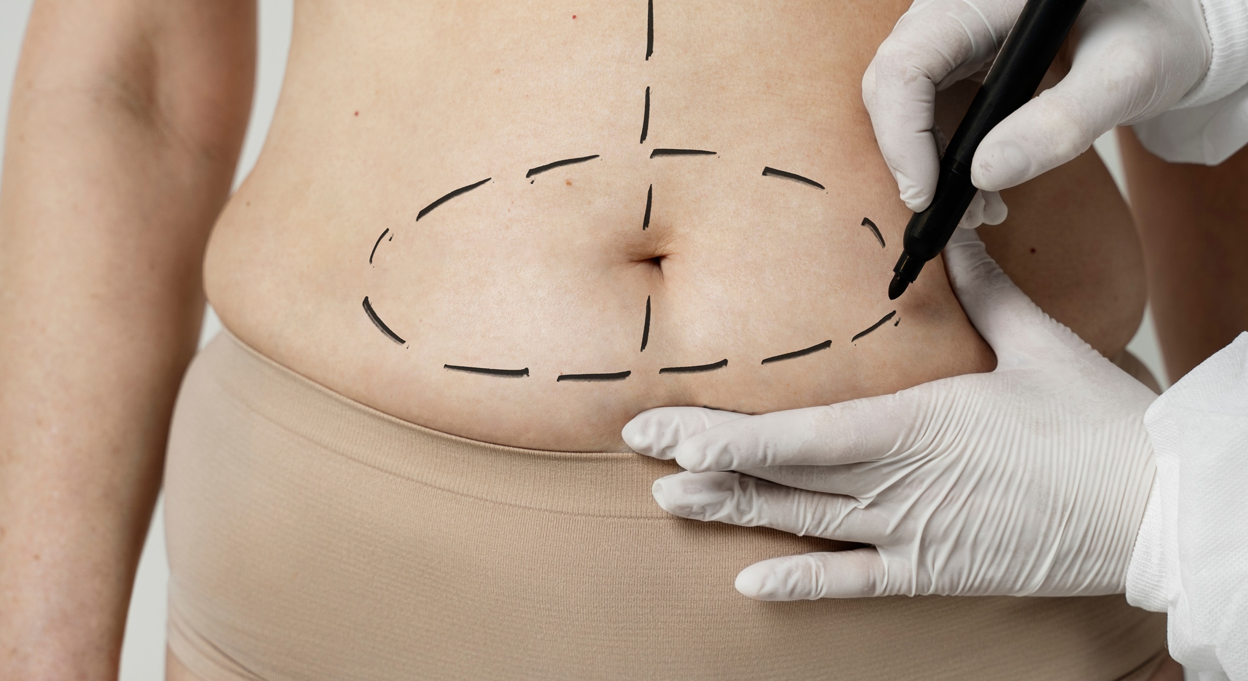 Front view woman with marker traces belly 1