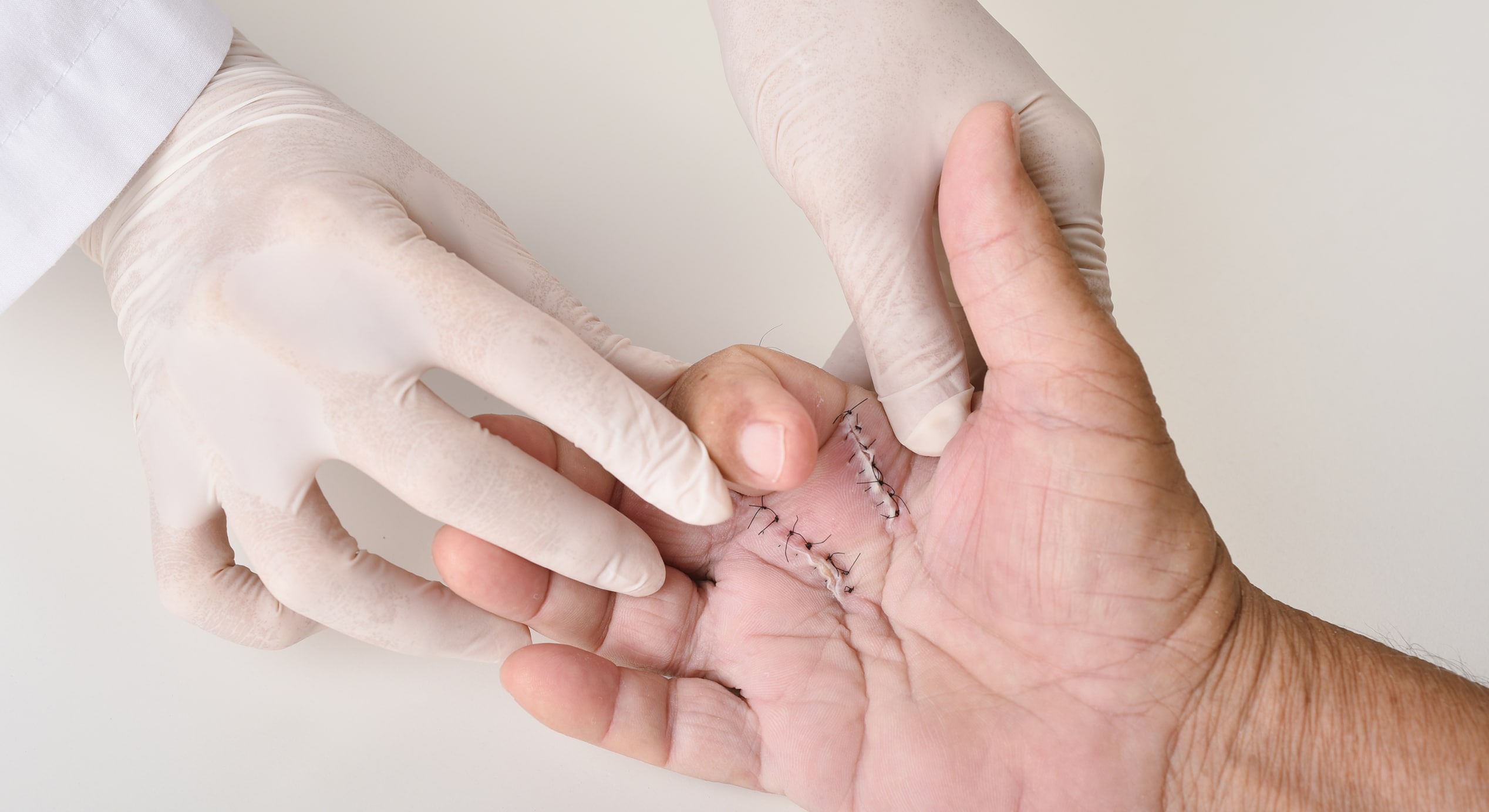 Hand surgery treatment trigger finger stiffness painful doctor treat patient39s hand injury hospital wound stitches…