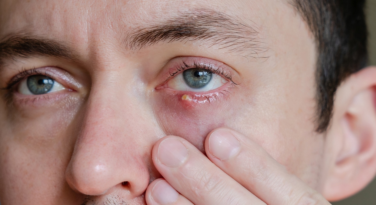 Infected chalazion stye barley hordeolum eye lower eyelid man 1