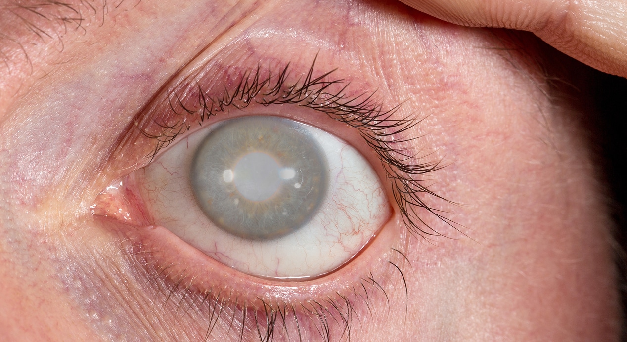 Male eye with cataract 1