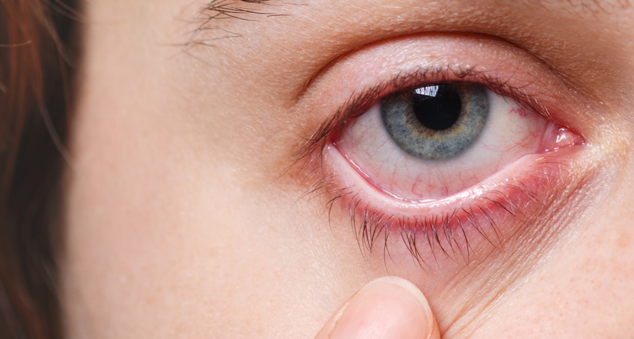 Medicine health care eyesight concept unrecognizable female shows her inflated red eye with blood capillary 1