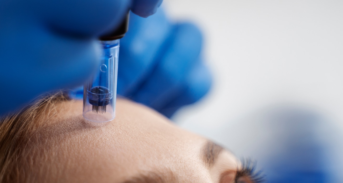 Patient undergoing microneedling procedure 1