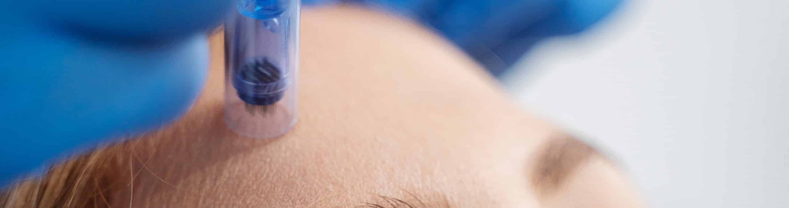 Patient undergoing microneedling procedure 2 1