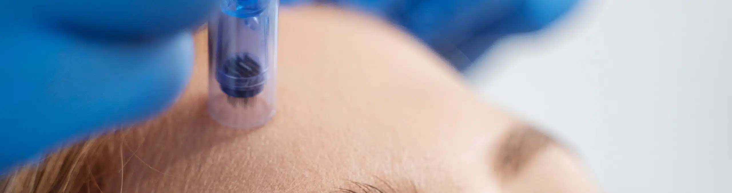 Patient receiving microneedling treatment