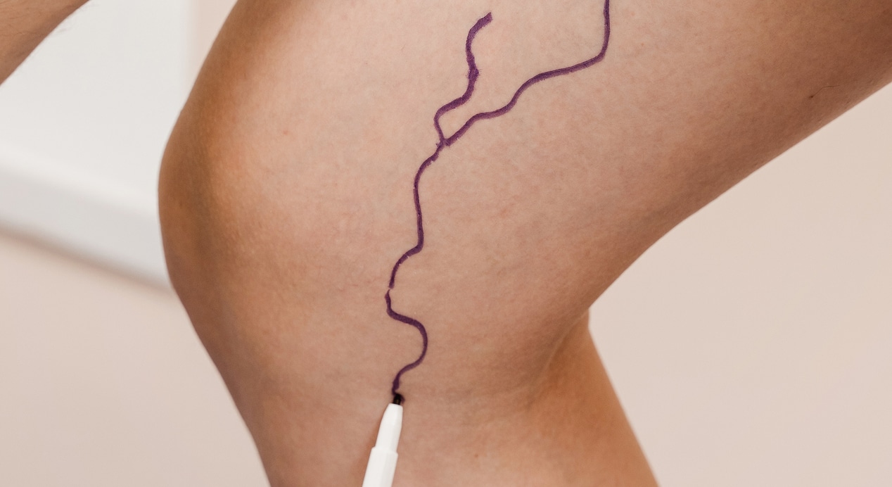 Phlebologist is marking legs before surgery remove veins vascular surgeon is marking leg veins vein markup 1