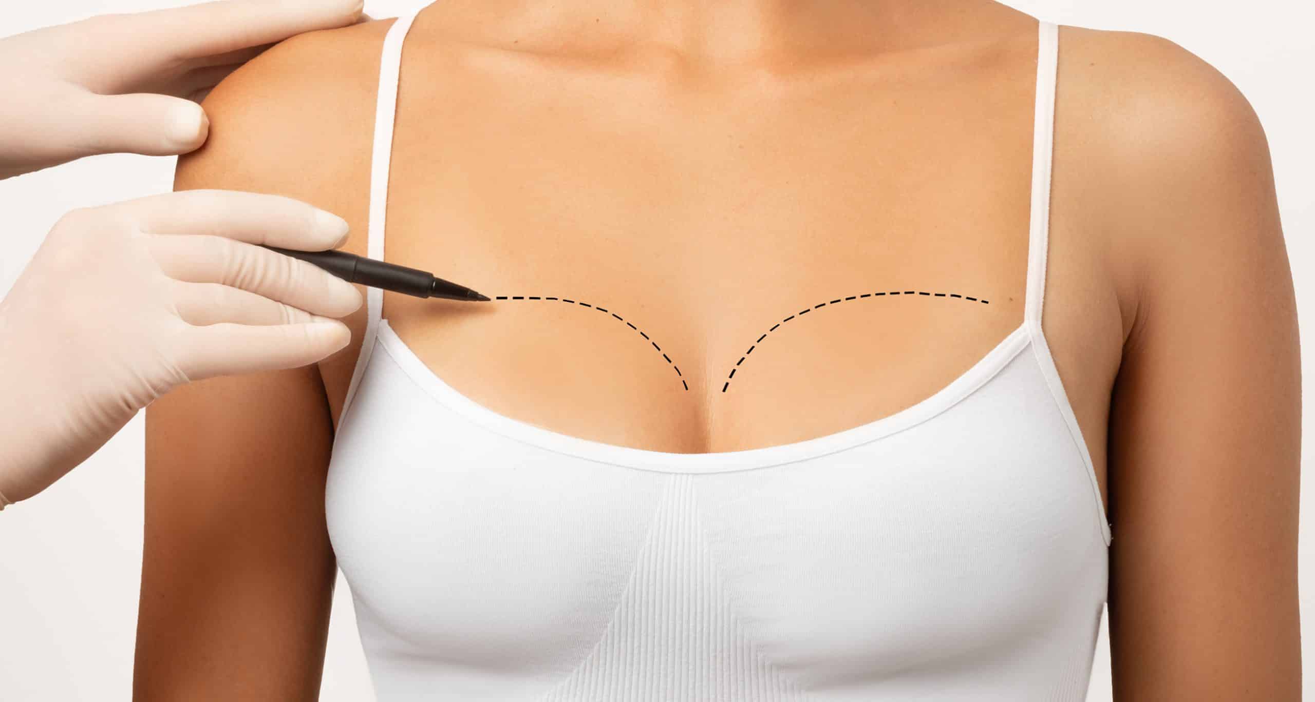 Plastic surgeon marking womans breast drawing lines chest white studio background closeup cropped 1