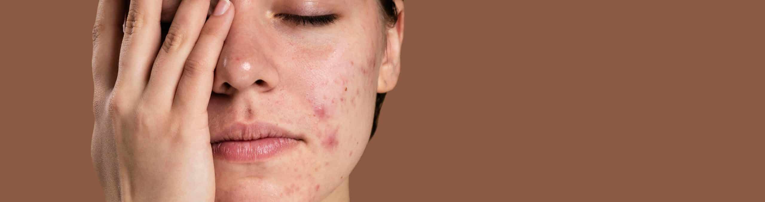 Portrait young woman being confident with her acne 1