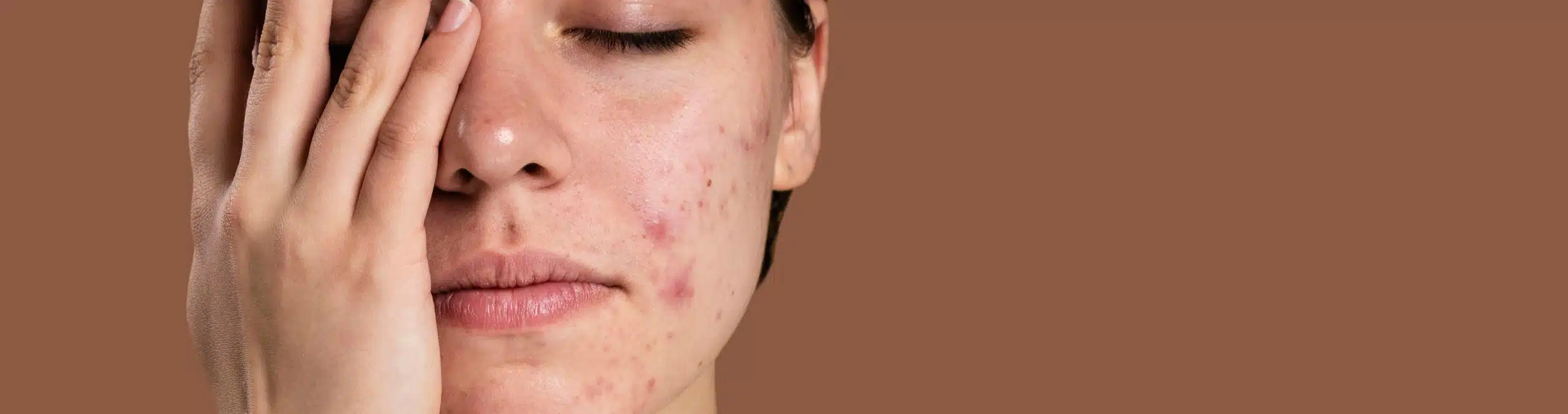 Portrait of a young woman with acne
