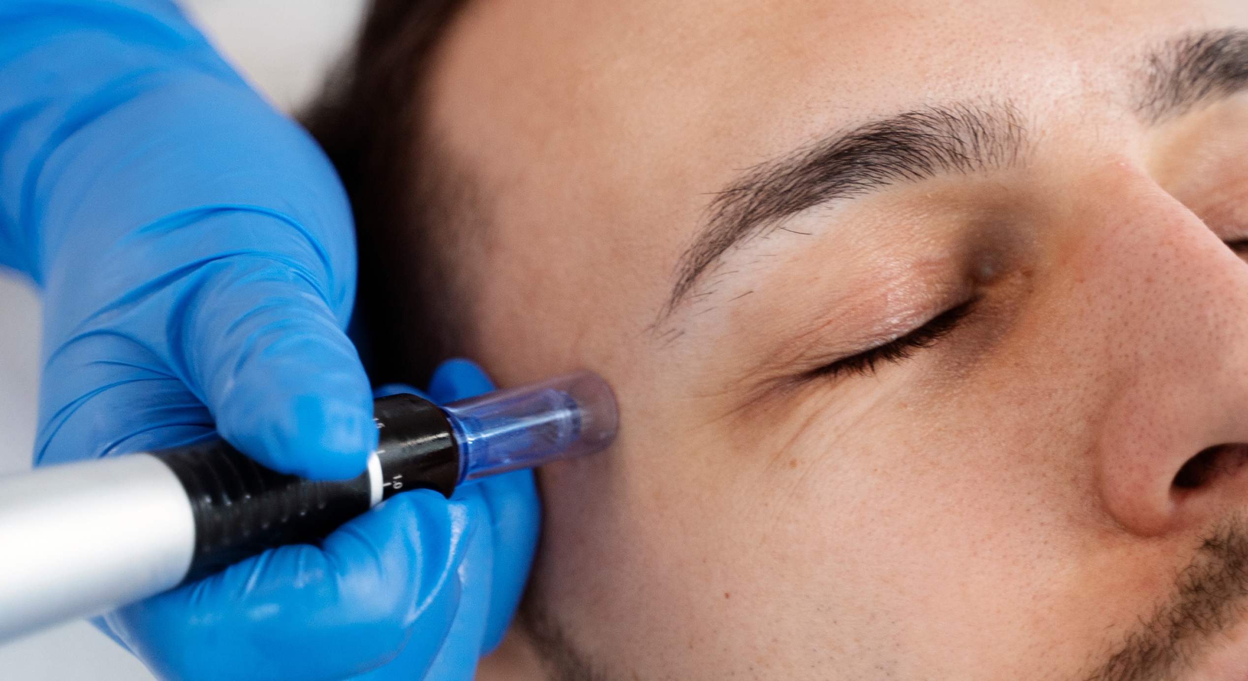 Preparing utensils microneedling procedure 1